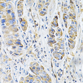 Immunohistochemistry of paraffin-embedded Human liver cancer using VAPB Polyclonal Antibody at dilution of  1:200 (40x lens).