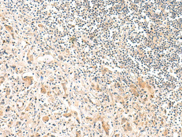 Immunohistochemistry of paraffin-embedded Human prost at e cancer tissue  using FNBP1L Polyclonal Antibody at dilution of 1:30(?200)