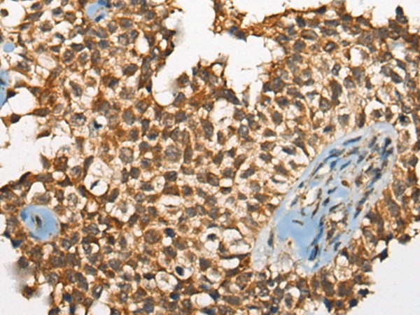 Immunohistochemistry of paraffin-embedded Human ovarian cancer tissue  using ODF2 Polyclonal Antibody at dilution of 1:110(?200)