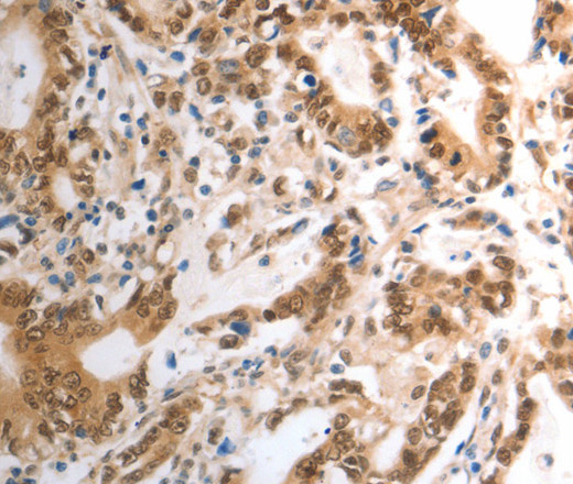 Immunohistochemistry of paraffin-embedded Human gastric cancer using RAD50 Polyclonal Antibody at dilution of 1:40