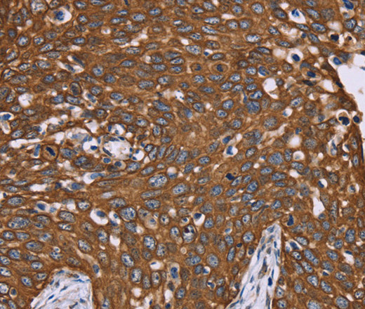 Immunohistochemistry of paraffin-embedded Human cervical cancer using PPIB Polyclonal Antibody at dilution of 1:40