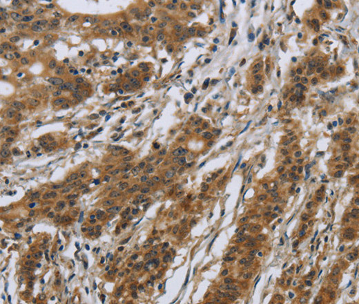 Immunohistochemistry of paraffin-embedded Human gastric cancer using IL5RA Polyclonal Antibody at dilution of 1:40