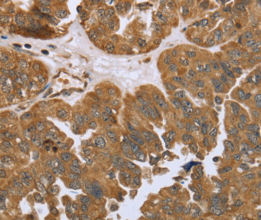 Immunohistochemistry of paraffin-embedded Human ovarian cancer tissue using IKBKE Polyclonal Antibody at dilution 1:30