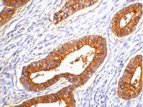 Immunohistochemistry of paraffin-embedded Human colon cancer tissue using CD66e Monoclonal Antibody at dilution of 1:200.