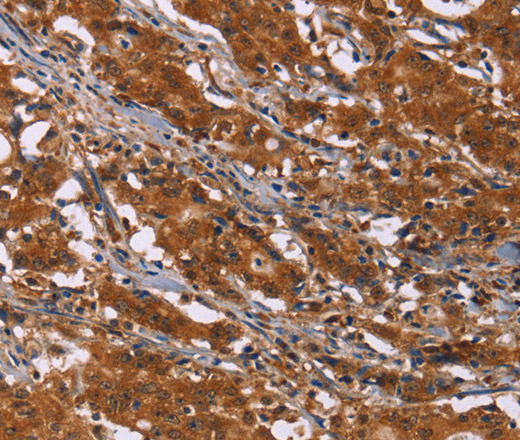 Immunohistochemistry of paraffin-embedded Human gasrtic cancer tissue using DCBLD2 Polyclonal Antibody at dilution 1:50