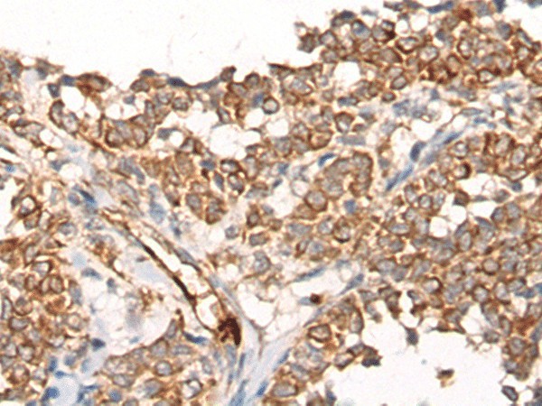 Immunohistochemistry of paraffin-embedded Human ovarian cancer tissue  using CA5B Polyclonal Antibody at dilution of 1:65(?200)