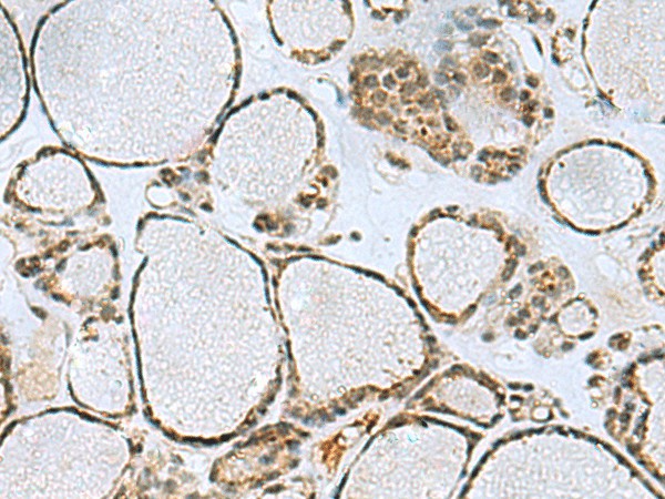 Immunohistochemistry of paraffin-embedded Human thyroid cancer tissue  using PTPA Polyclonal Antibody at dilution of 1:50(?200)