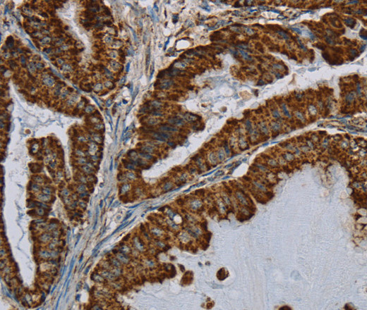 Immunohistochemistry of paraffin-embedded Human esophagus cancer using HSD17B2 Polyclonal Antibody at dilution of 1:50