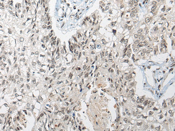 Immunohistochemistry of paraffin-embedded Human lung cancer tissue  using DGKI Polyclonal Antibody at dilution of 1:80(?200)