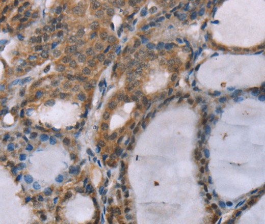 Immunohistochemistry of paraffin-embedded Human thyroid cancer using ACTN2 Polyclonal Antibody at dilution of 1:30