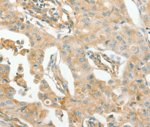 Immunohistochemistry of paraffin-embedded Human lung cancer using ACE1 Polyclonal Antibody at dilution of 1:70