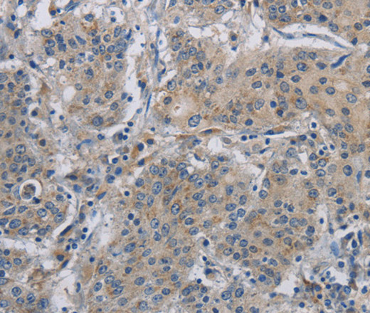 Immunohistochemistry of paraffin-embedded Human gastric cancer using DNAJB4 Polyclonal Antibody at dilution of 1:50