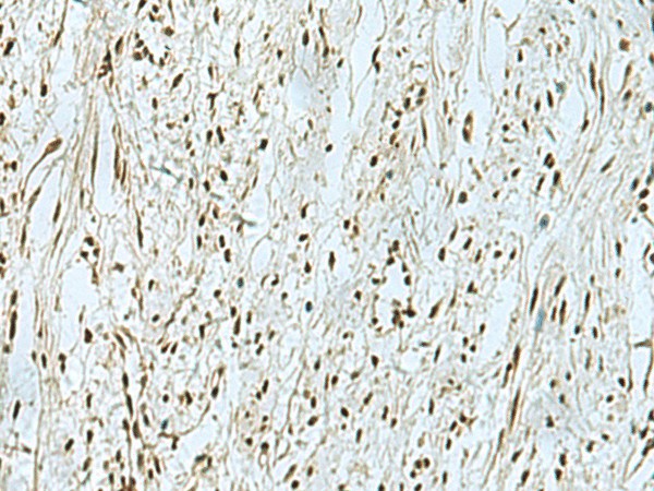 Immunohistochemistry of paraffin-embedded Human breast cancer tissue  using THTPA Polyclonal Antibody at dilution of 1:90(?200)