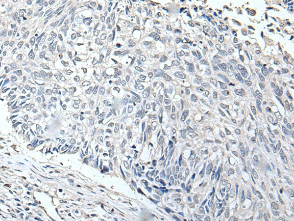 Immunohistochemistry of paraffin-embedded Human lung cancer tissue  using RERG Polyclonal Antibody at dilution of 1:65(?200)