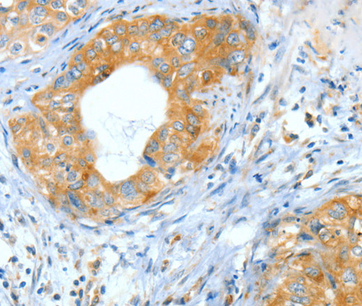 Immunohistochemistry of paraffin-embedded Human cervical cancer using ASNS Polyclonal Antibody at dilution of 1:60