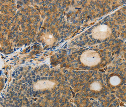 Immunohistochemistry of paraffin-embedded Human thyroid cancer using MSN Polyclonal Antibody at dilution of 1:30