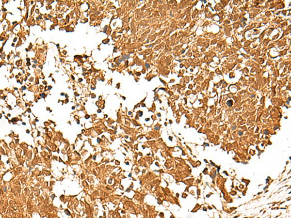 Immunohistochemistry of paraffin-embedded Human lung cancer tissue  using TCF7 Polyclonal Antibody at dilution of 1:30(?200)