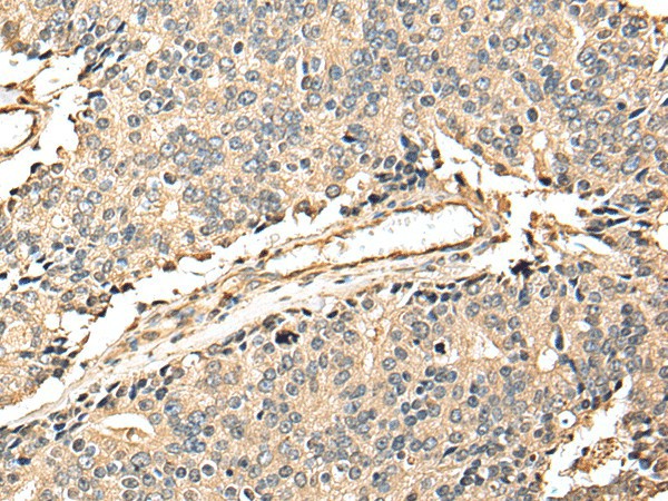 Immunohistochemistry of paraffin-embedded Human prost at e cancer tissue  using EEF1E1 Polyclonal Antibody at dilution of 1:25(?200)