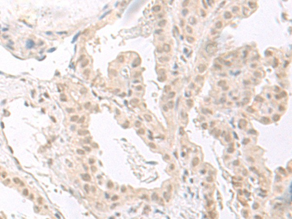 Immunohistochemistry of paraffin-embedded Human thyroid cancer tissue  using HOOK2 Polyclonal Antibody at dilution of 1:30(?200)