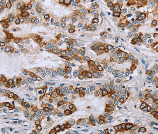 Immunohistochemistry of paraffin-embedded Human liver cancer tissue using NMT1 Polyclonal Antibody at dilution 1:45