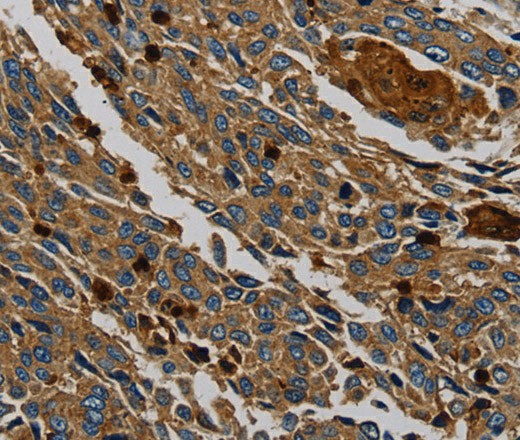 Immunohistochemistry of paraffin-embedded Human lung cancer tissue using PER2 Polyclonal Antibody at dilution 1:50