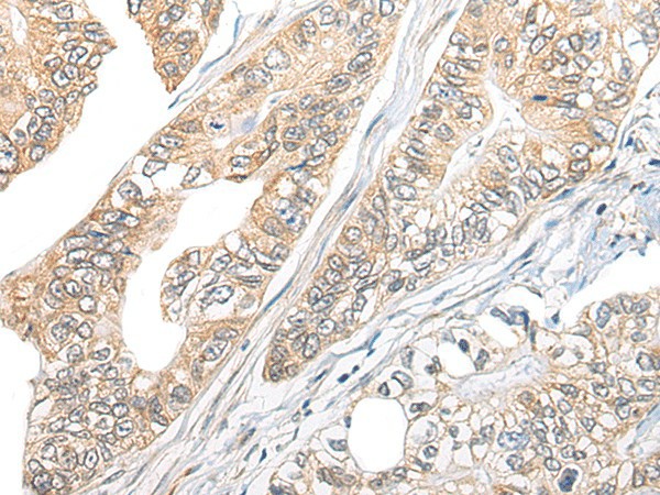 Immunohistochemistry of paraffin-embedded Human gastric cancer tissue  using TBCB Polyclonal Antibody at dilution of 1:25(?200)