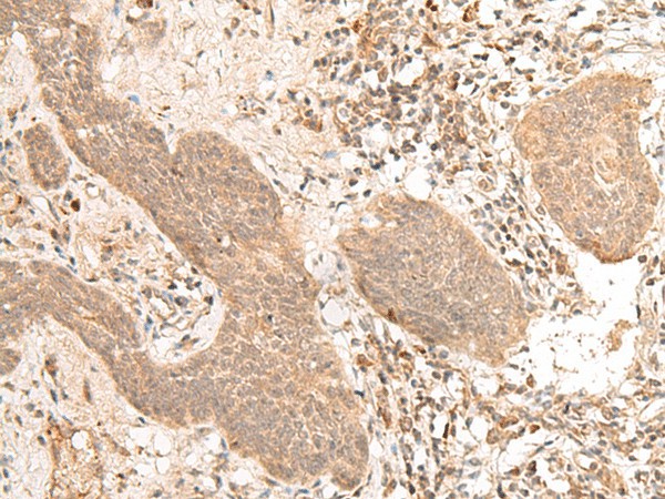 Immunohistochemistry of paraffin-embedded Human esophagus cancer tissue  using FIZ1 Polyclonal Antibody at dilution of 1:40(?200)