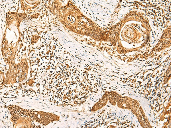 Immunohistochemistry of paraffin-embedded Human esophagus cancer tissue  using GSG1L Polyclonal Antibody at dilution of 1:50(?200)