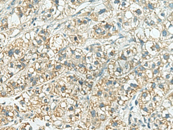 Immunohistochemistry of paraffin-embedded Human liver cancer tissue  using SORBS2 Polyclonal Antibody at dilution of 1:160(?200)