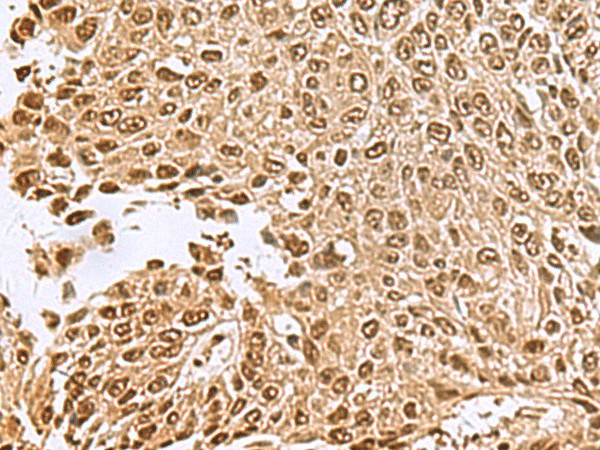 Immunohistochemistry of paraffin-embedded Human lung cancer tissue  using NVL Polyclonal Antibody at dilution of 1:70(?200)