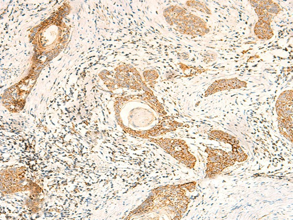 Immunohistochemistry of paraffin-embedded Human esophagus cancer tissue  using MT-CO2 Polyclonal Antibody at dilution of 1:60(?200)