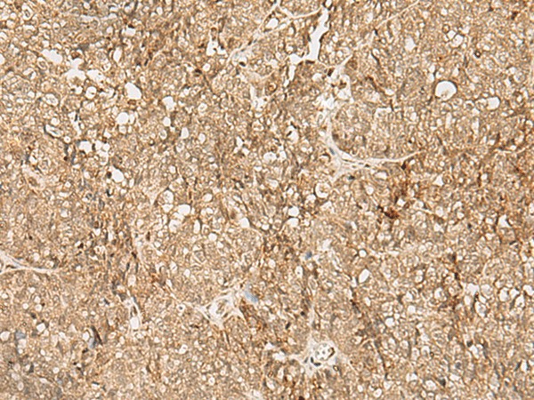 Immunohistochemistry of paraffin-embedded Human ovarian cancer tissue  using SNAPC5 Polyclonal Antibody at dilution of 1:25(?200)