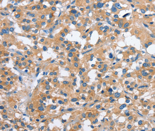 Immunohistochemistry of paraffin-embedded Human thyroid cancer using PAK2 Polyclonal Antibody at dilution of 1:40