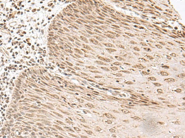 Immunohistochemistry of paraffin-embedded Human esophagus cancer tissue  using LGALS4 Polyclonal Antibody at dilution of 1:35(?200)