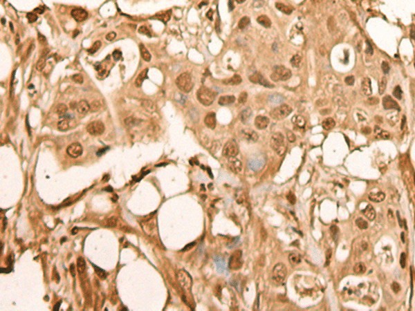 Immunohistochemistry of paraffin-embedded Human colorectal cancer tissue  using BRF2 Polyclonal Antibody at dilution of 1:40(?200)