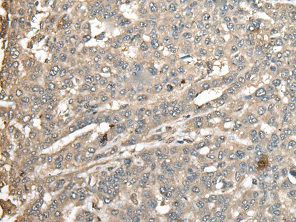 Immunohistochemistry of paraffin-embedded Human liver cancer tissue  using ATXN3 Polyclonal Antibody at dilution of 1:100(?200)