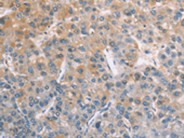 Immunohistochemistry of paraffin-embedded Human liver cancer tissue  using ZAP70  Polyclonal Antibody at dilution of 1:50(?200)