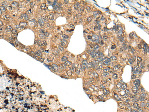 Immunohistochemistry of paraffin-embedded Human colorectal cancer tissue  using PPP3R1 Polyclonal Antibody at dilution of 1:80(?200)