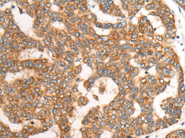 Immunohistochemistry of paraffin-embedded Human liver cancer tissue  using CDON Polyclonal Antibody at dilution of 1:65(?200)