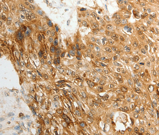 Immunohistochemistry of paraffin-embedded Human esophagus cancer tissue using TENM3 Polyclonal Antibody at dilution 1:50