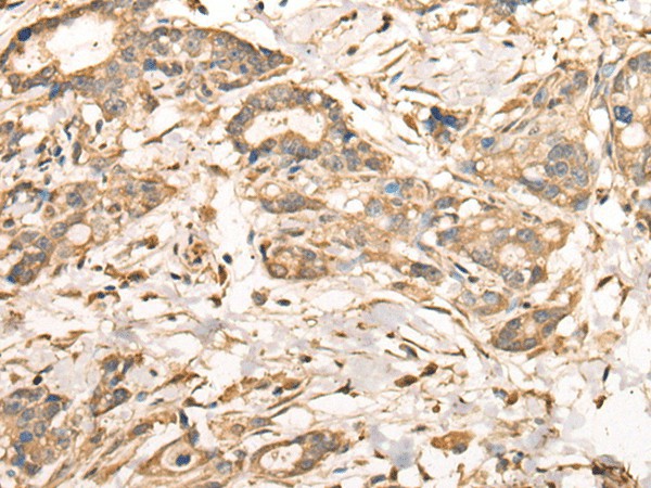 Immunohistochemistry of paraffin-embedded Human gastric cancer tissue  using VTI1A Polyclonal Antibody at dilution of 1:35(?200)