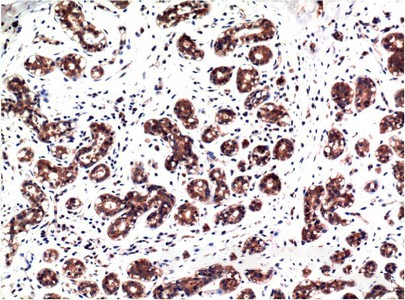 Immunohistochemistry of paraffin-embedded Human breast carcinoma tissue with Phospho-ERK 1/2 (Tyr222/205) Monoclonal Antibody at dilution of 1:200