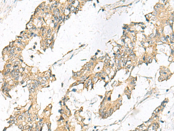 Immunohistochemistry of paraffin-embedded Human colorectal cancer tissue  using MGAT4B Polyclonal Antibody at dilution of 1:50(?200)