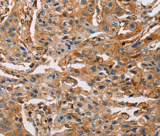 Immunohistochemistry of paraffin-embedded Human lung cancer using ACTA1 Polyclonal Antibody at dilution of 1:65