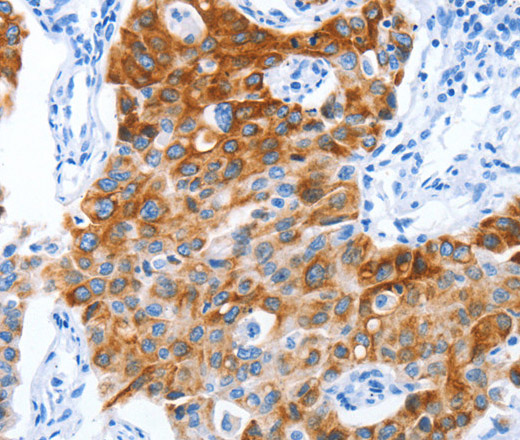 Immunohistochemistry of paraffin-embedded Human lung cancer tissue using CD133 Polyclonal Antibody at dilution 1:40