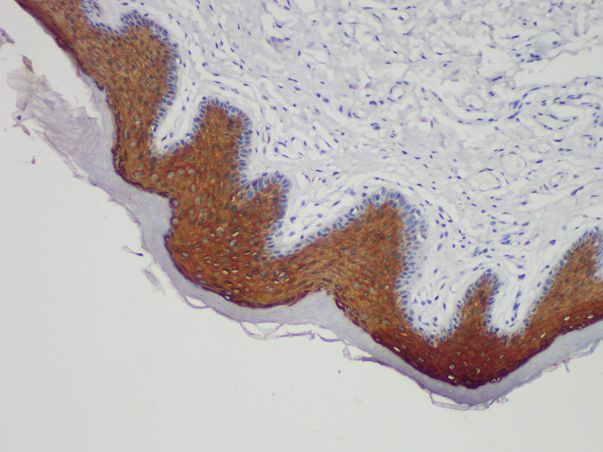 Immunohistochemistry of paraffinembedded Human lung squamous cell carcinoma with Cytokeratin 10 Monoclonal Antibody(Antigen repaired by EDTA).