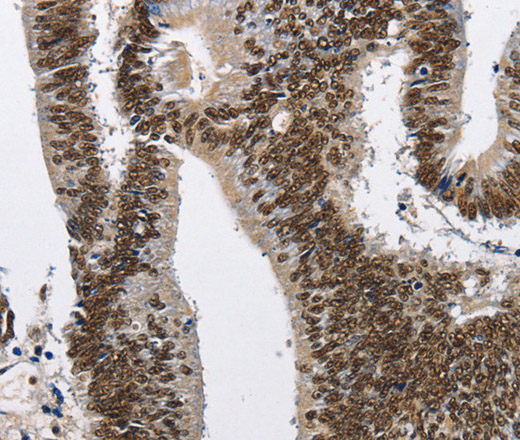 Immunohistochemistry of paraffin-embedded Human colon cancer tissue using CMTM2 Polyclonal Antibody at dilution 1:60