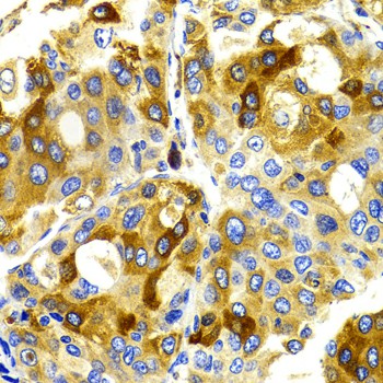 Immunohistochemistry of paraffin-embedded Human liver cancer using CDK20 Polyclonal Antibody at dilution of 1:100 (40x lens).