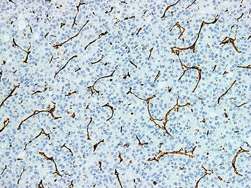 Immunohistochemistry of paraffinembedded Human liver cancer tissue with Vimentin Monoclonal Antibody(Antigen repaired by EDTA).