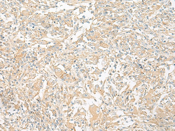 Immunohistochemistry of paraffin-embedded Human liver cancer tissue  using GP6 Polyclonal Antibody at dilution of 1:40(?200)